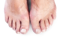 How Psoriatic Arthritis Can Affect the Feet