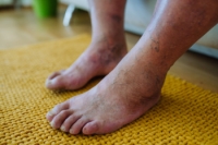 Ways That Diabetes Affects the Feet
