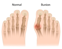 A Bump Can Indicate a Bunion Has Formed